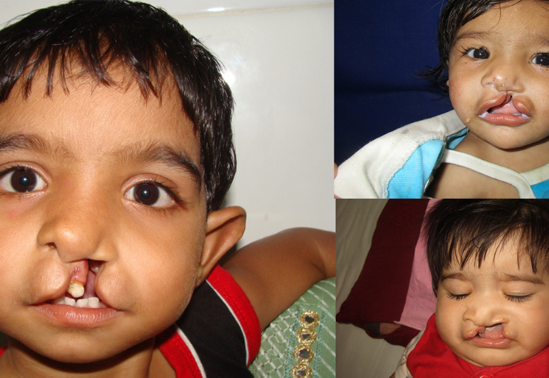 cleft lip, cleft palate surgeries free